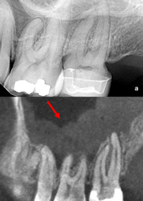 Maxillary mucositis induced by